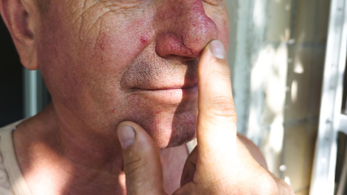 what-causes-rhinophyma